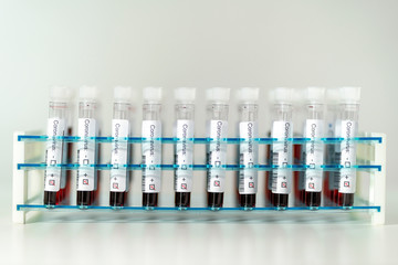 Positive results of corona virus tests. Many blood test tube in the laboratory.