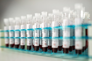 Positive results of corona virus tests. Many blood test tube in the laboratory.