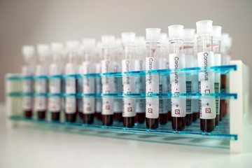 Positive results of corona virus tests. Many blood test tube in the laboratory.