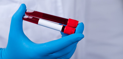 Coronavirus 2019-nCoV Blood Sample.