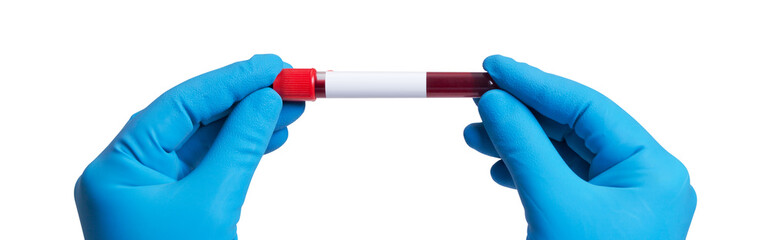 Coronavirus 2019-nCoV Blood Sample.