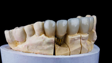 Fototapeta premium high-quality veneers and crowns for a dental model, shot on a black background