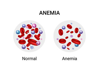 Vector illustration of the difference of number of healthy red blood cells. Anemia and normal.