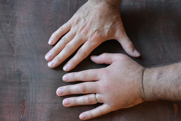 Swollen fist compared with healthy fist