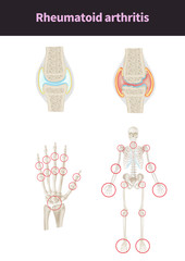 medical illustration for explain diseases