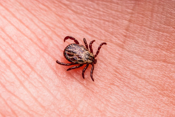 Encephalitis Infected Tick Insect Crawling on Skin. Encephalitis Virus or Lyme Borreliosis Disease Infectious Dermacentor Tick Arachnid Parasite Macro.