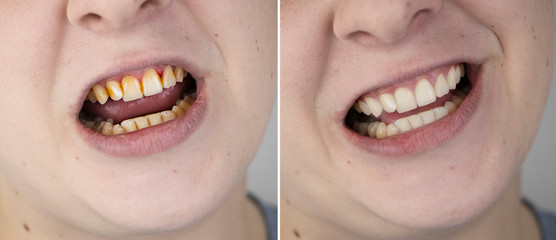 Teeth of a man before and after bleaching. The dentist removed yellow plaque from tooth enamel. The...