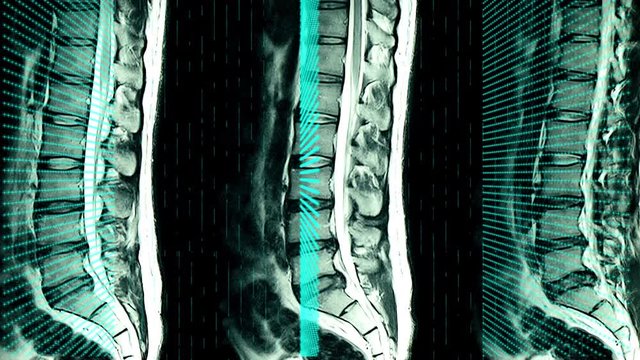  An MRI scan of lumbar and sacrum of a patient with herniated disc with grid of blue green lights animation of the scanning process.