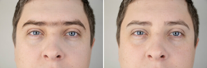 Fused eyebrows and sinofreeze in men. Photo before and after modeling eyebrows in a guy. Male...