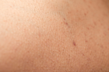 Fototapeta premium Folliculitis on skin - hormonal imbalance