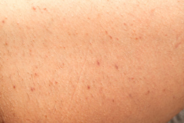 Folliculitis on skin - hormonal imbalance