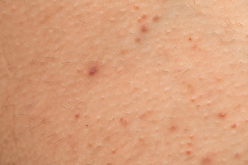 Folliculitis on skin - hormonal imbalance