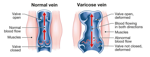 Varicose veins and normal veins, medical illustration, labeled_2