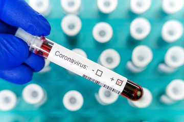 Fototapeta premium Health worker holds one test-tube indicating positive results of corona virus test. Many blood tube-tests as a background.