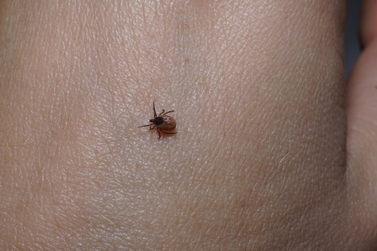 Female Tick ( Ixodes Scapularis) Crawling On Skin Ready To Bite 