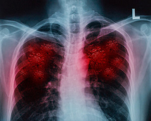 chest x-ray with lung injury from corona virus