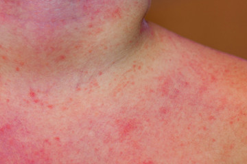 A child with severe heat rash on his neck and chest coused by warm and humid summer.