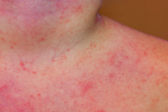 A Child With Severe Heat Rash On His Neck And Chest Coused By Warm And Humid Summer.