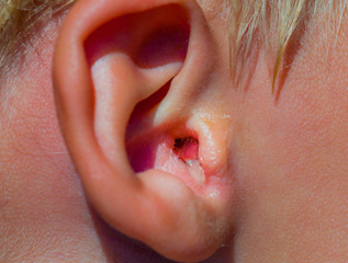 A little child with ear infection. From infected outer auditoy canal slime is slowely comming out...