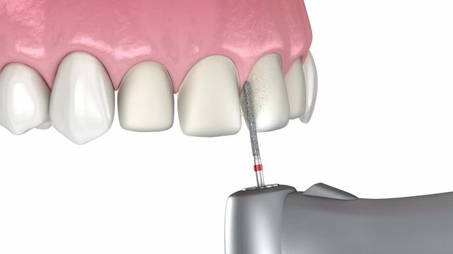 Veneers - preparation and placement of dental veneers over central incisor and lateral incisor. Medically accurate tooth 3D animation