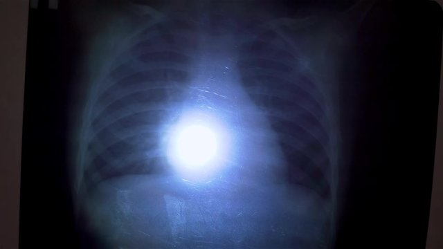 Epidemiologist shines flashlight on x ray of lungs to refute diagnosis of viral pneumonia during world pondemia of corona virus. Modern technologies saving life