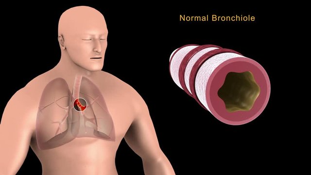 Biomedical animation of asthma in human lungs.
