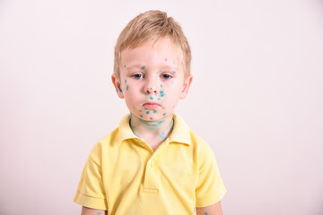 Young toddler,boy with chickenpox. Sick child with chickenpox. Varicella virus or Chickenpox bubble...