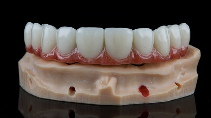 temporary upper jaw prosthesis with a pink gum on a model made on a 3D printer © Dental Pro Content