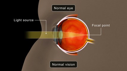Differences between Hyperopia (farsightedness) and Myopia (nearsightedness).