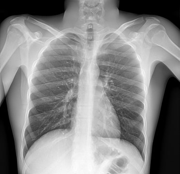 X-ray image of lung with pneumonia.