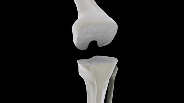 Biomedical animation of a knee replacement.