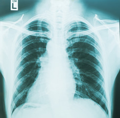 Film chest x-ray To check the patient's lungs Coronavirus or Covid-19