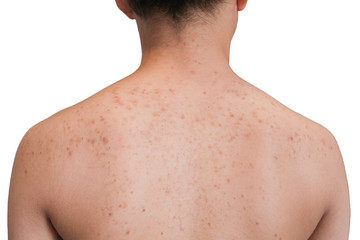 Asian teenage girls scratching pimples on the back. With many red spots on the back.