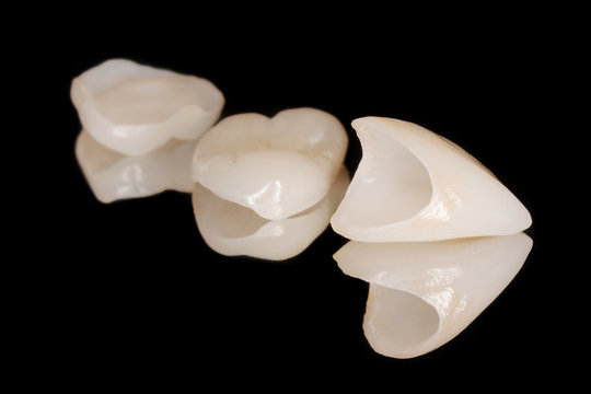 Zahnkrone Veneer aus Vollkeramik