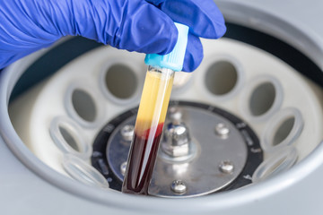 laboratory plasma blood sample analysis