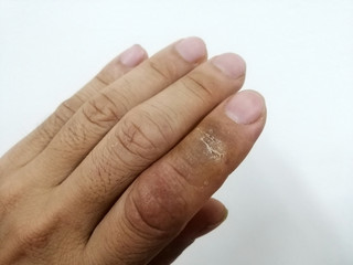 The index finger looks dry, cracked and peeled.