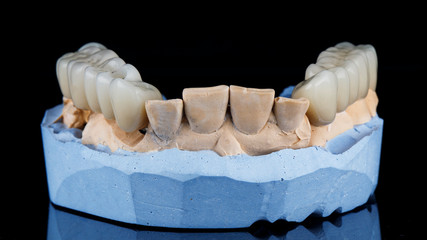 gypsum model with two bridges on the chewing parts of the jaw