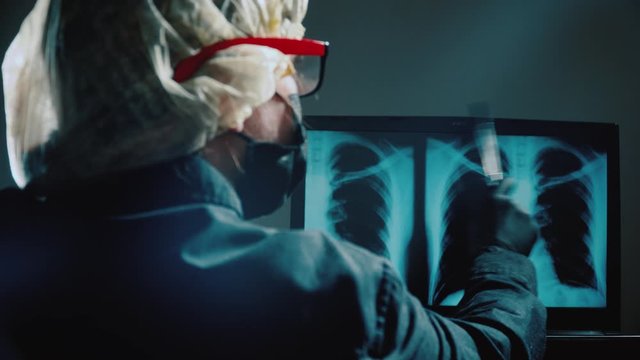 A doctor in a black mask and surgical gloves shows the foci of the coronavirus COVID-19 in a fluorography scan of the lungs.