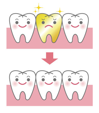 金歯とセラミックの比較イメージ