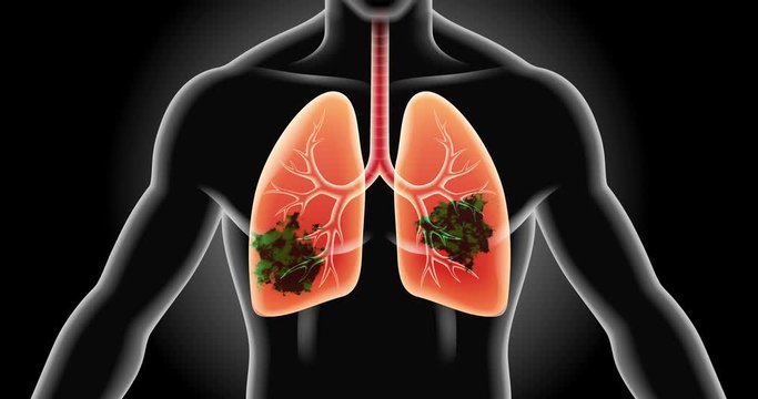 Viral lung respiratory infections background stock video footage.
