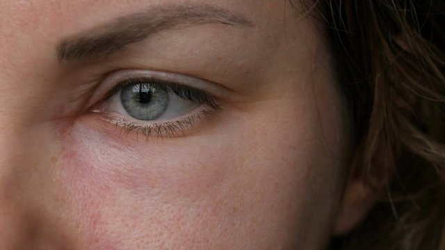 Young girl with an allergic reaction on the face and eyes, Quincke's edema. Swelling of the face from nose to eyes in a young woman. Angioedema close up view