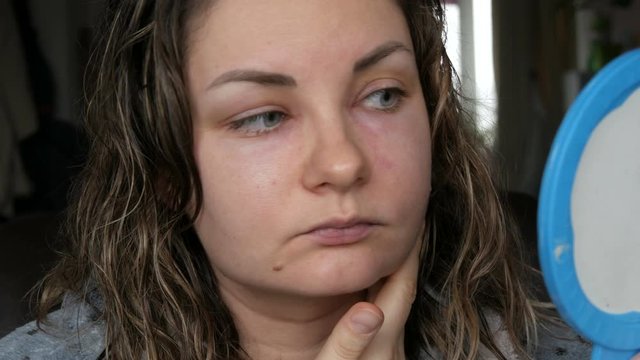 Young girl with an allergic reaction on the face and eyes, Quincke's edema. Swelling of the face from nose to eyes in a young woman. Angioedema, Woman touches her swollen face looking in the mirror
