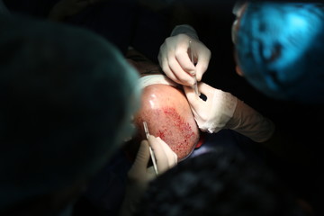 9 January 2014 Istanbul, Turkey. Hair transplantation is a surgical technique that moves hair follicles from a part of the body called .