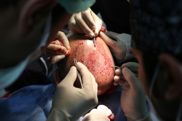 9 January 2014 Istanbul, Turkey. Hair transplantation is a surgical technique that moves hair...