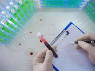 Researcher looking on diseased blood sample in a test tube and make a notes. View from a researcher's eyes.