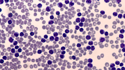 Leukemia Awareness: Photomicrograph of pleural effusion in a patient with chronic lymphocytic leukemia (CLL), which is the same disease as small lymphcytic lymphoma (SLL), a cancer of lymphcytes. 