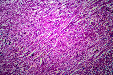 Uterine tumour, light micrograph