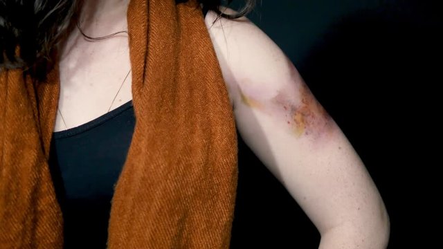 Woman revealing hematoma on arm, victim of femicide