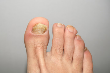 Young guy barefoot fingers with sick onycho mycosis nails,dermatologic medical 