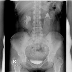 Intravenous urogram (IVU). Erect position. Ureters are without signs of narrowing, contrast agent passing down the ureters into the bladder with no filling defects within the ureters.